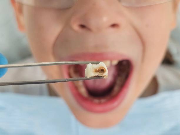 Best Root Canal Emergency Dentist  in Buna, TX